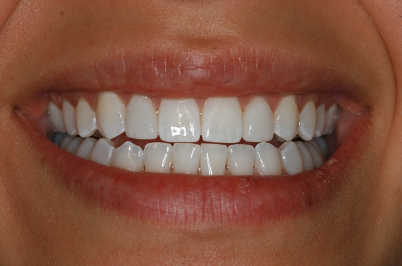Cosmetic Dentistry and TMJ Undersized Lateral Incisors Can Corrected